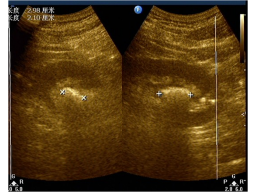 第十一章 泌尿系超声诊断