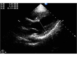 第十八章 心脏超声诊断（基础篇）